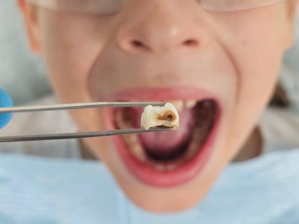 Best Emergency Gum Treatment in Woodsfield, OH